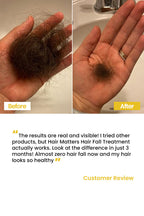 Hair Fall Treatment Oil to Reduce Hair Fall