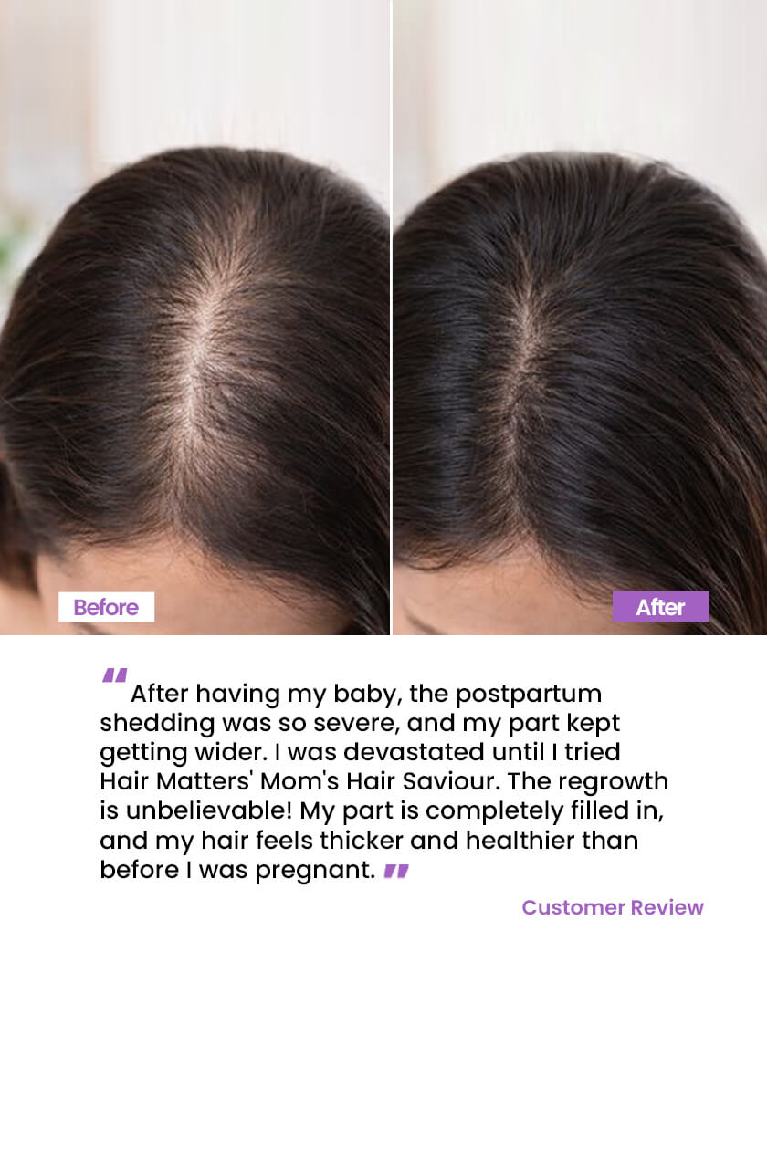 Mom’s Hair Saviour for Reducing Postpartum Hair Fall